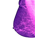 Breast cancer screening,X-ray