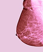 Breast cancer screening,X-ray
