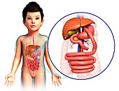 Child's gastric bypass,illustration