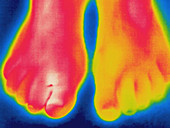 Thermogram of an infected toe