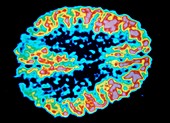 PET scan of a brain with Alzheimer's disease