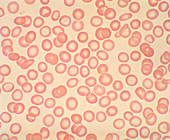 Light micrograph of iron deficient red blood cells
