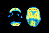 PET scans of ormal and Alzheimer's brain