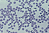 Sickle Cell anaemia