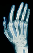 Coloured X-ray of hand with rheumatoid arthritis