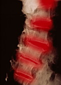 Osteoarthritic spine X-ray