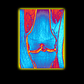 Knee with osteoarthritis