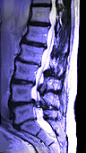 Arthritic Spine