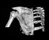 3D CT Reconstruction Shoulder