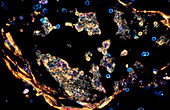 Light micrograph of Pneumocystis carinii in AIDS
