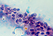 LM of Pneumocystis carinii cysts from AIDS lung