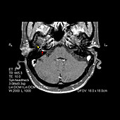 MRI of Right Bells Palsy