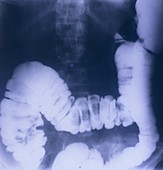 X-ray of colon in ulcerative colitis