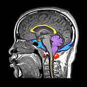 MRI of Brain with Chiari I Malforformation