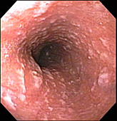 Candida esophagitis