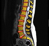Benign Cyst in the Spine