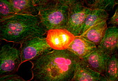 Cancer cells, light micrograph