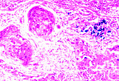 Micrograph of smokers lung tissue