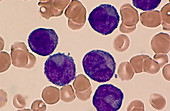 Acute Myeloblastic Leukemia