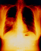 Coloured chest X-ray of lung cancer