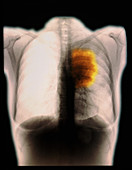 Coloured chest X-ray showing a lung cancer