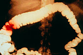 Colon cancer,X-ray