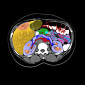 CT Cross Section of Liver Tumor