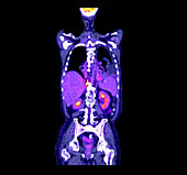 PET - CT Scan of Lung Cancer