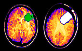CT scan of brain glioma and tumor removal
