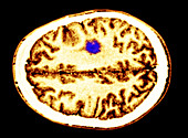 Glioma brain tumor