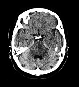 CT image of Infiltrating Glioma