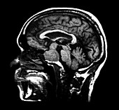 Large Pituitary Adenoma