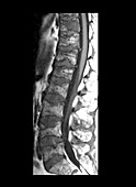 MRI of Multiple Myeloma