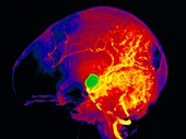 Coloured angiogram of cerebral aneurysm