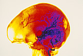 Cerebral angiogram