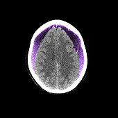 CT Scan of a Brain With Internal Bleeding