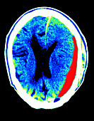 Cerebral CT showing subdural haematoma