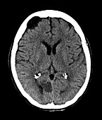 CT image of Head