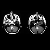 MRI of Hemangioblastoma