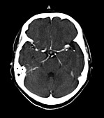CT Image of Head