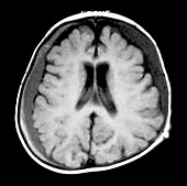 MRI of Subdural Hematomas