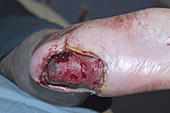 Diabetic foot with large ulcer