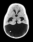 Dandy-Walker Malformation