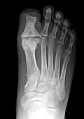 Foot Amputation Resulting from Diabetes