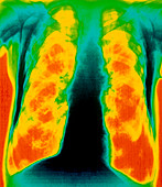 False-colour X-ray of chest: pulmonary emphysema