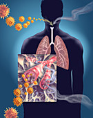 Emphysema