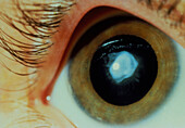 Anterior subcapsular cataract on eye