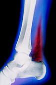 Coloured X-ray of foot with necrotising fasciitis