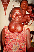 Woman with goitre,swelling of the neck