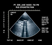 Ultrasound of Gallstones (choleylithiasis)